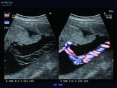 Umbilical Cord with eFLOW displays blood flow in detail