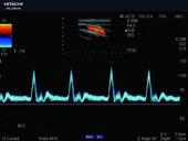 Carotid artery with Compound Gated Pulse Wave Doppler
