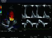 Dual Doppler enables observation of 2 Doppler waveforms at the same heartbeat