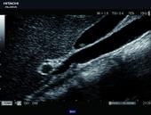 Gallbladder polyp in high quality zoom