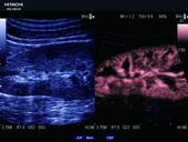 Kidney with eFLOW+x Flow Emphasis x DDD