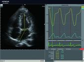 Quantification of intracardiac volume - 2DTT