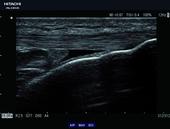 Tibial tuberosity with AIP HI REZ and SCI+