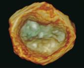 3D zoomClear structures of the mitral valve