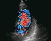 VFM - Apical four-chamber view - blood flow streamlines in diastole