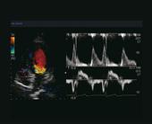 Dual Gate Doppler: Combination of PW and TDI allows simulaneous evaluation of wall motion and hemodynamics