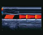 Wave Intensity (Ventriculo-Arterial Coupling): WI is a new hemodynamic index which is potentially useful for analyzing interaction of the cardiovascular system (heart and blood vessels)