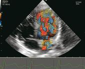 VFM - Vector Flow Mapping - Evaluation of cardiac blood flow motion
