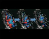 VFM - Flow Patterns in an apical long axis view - Rapid inflow phase, slow inflow phase 1, slow inflow phase 2 (left to right)