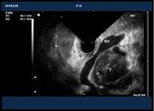 Pancreatic tumor