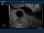 Esophageal tumor