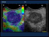Ductal adenocarcinoma of pancreas