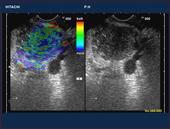 Pseudotumoral pancreatitis