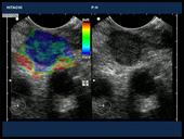 Malignant lymph node