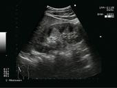 Abdomen - Kidney