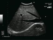 Abdomen - Liver