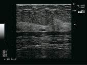 Breast - Cyst