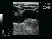 Carotid - Subclavian Artery IMT thickening