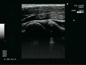 MSK - Articulatio humeroradiallis