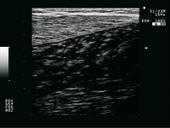 MSK - Gastrocnemius muscle