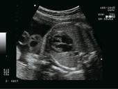 OBGYN - Fetal heart