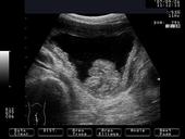 Bladder tumor