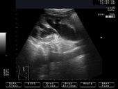 Hydronephrosis