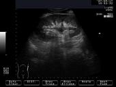 Hydronephrosis