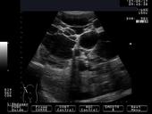 Polycystic Kidney
