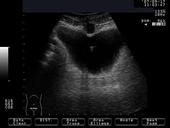 Urachal cyst