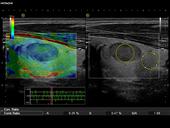 RTE and strain ratio measurement of thyroid nodule