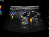 Complex thyroid nodule in trapezoid mode