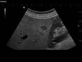 Small liver metastasis