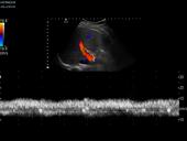 Triplex mode showing normal antegrade flow in portal vein