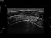 Rotator cuff tear