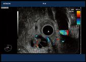 Adenocarcinoma of pancreas