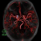 Coloured 3D Volume Rendering reconstruction of post-contrast brain. Detailed visualization of post-operative left cerebral artery aneurysm.*