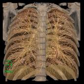 Coloured 3D Volume Rendering reconstruction with cut-plane option allows visualization of the lung fields for pneumonia.*