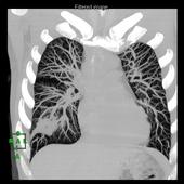 Maximum Intensity Projection reconstruction in grey scale for lung pneumonia.*
