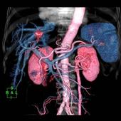 Coloured 3D Volume Rendering reconstruction with fusion images showing arterial and portal phase post contrast abdominal angiography using Intelli EC and PredictScan (Bolus-Tracking). The HCC (hepatocellular carcinoma) is visible in red.*