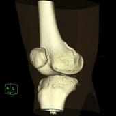 Coloured 3D Volume Rendering reconstruction of helical scan of knee joint.**Images acquired by AZE Virtual Place