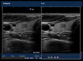 Real-time tissue adaptive filter