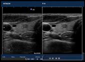 Real-time tissue adaptive filter