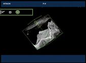 3D view of the bladder