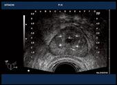 Cryotherapy of prostate: transverse