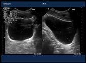 Bladder volume measurement