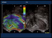 Hitachi Real-time Tissue Elastography (HI-RTE)