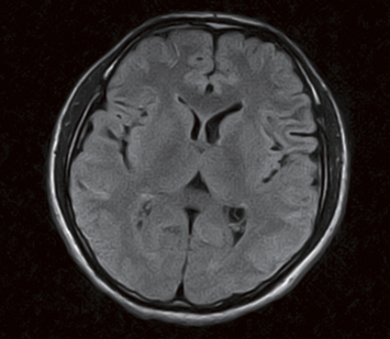 Brain - FLAIR axial scan with RADAR (Radial Acquisition Regime) motion compensation technique enables clear and motion-free imaging