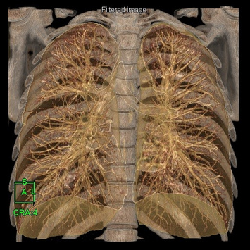 Coloured 3D Volume Rendering reconstruction with cut-plane option allows visualization of the lung fields for pneumonia.
