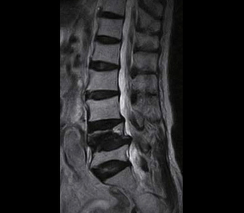 Lumbar Spine - Sagittal T2 FSE - Large 350mm field of view allows complete lumbar and sacral spine visualization